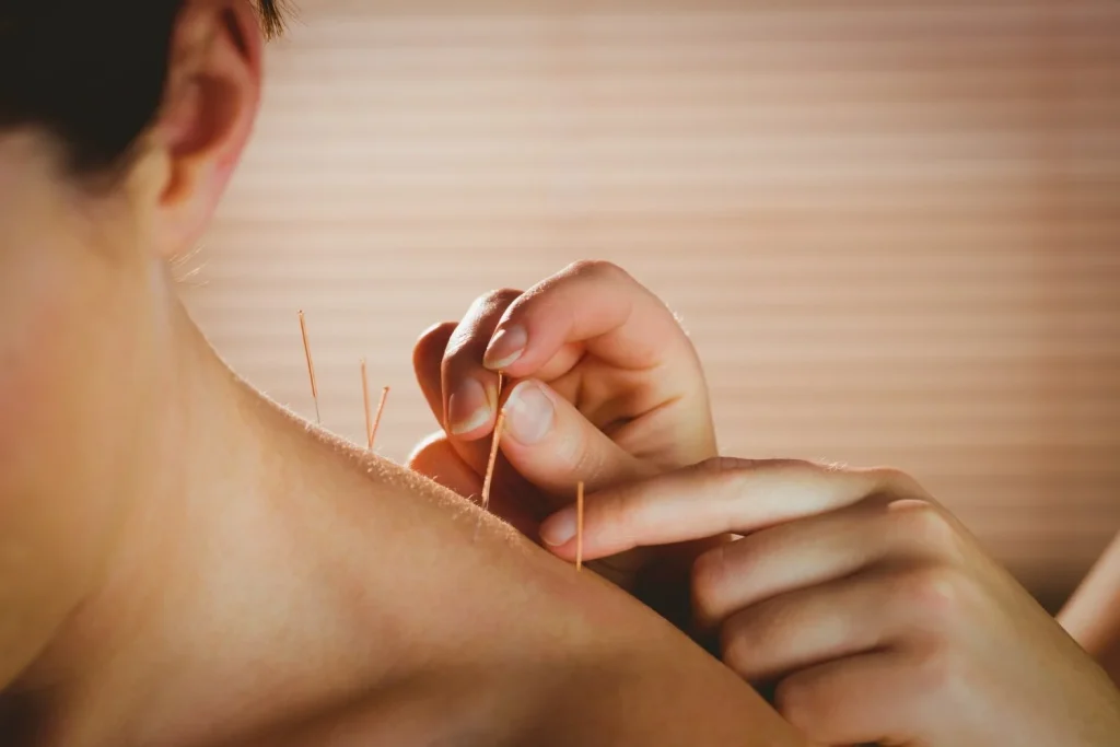 Acupuncture treatment at Joayo Therapy